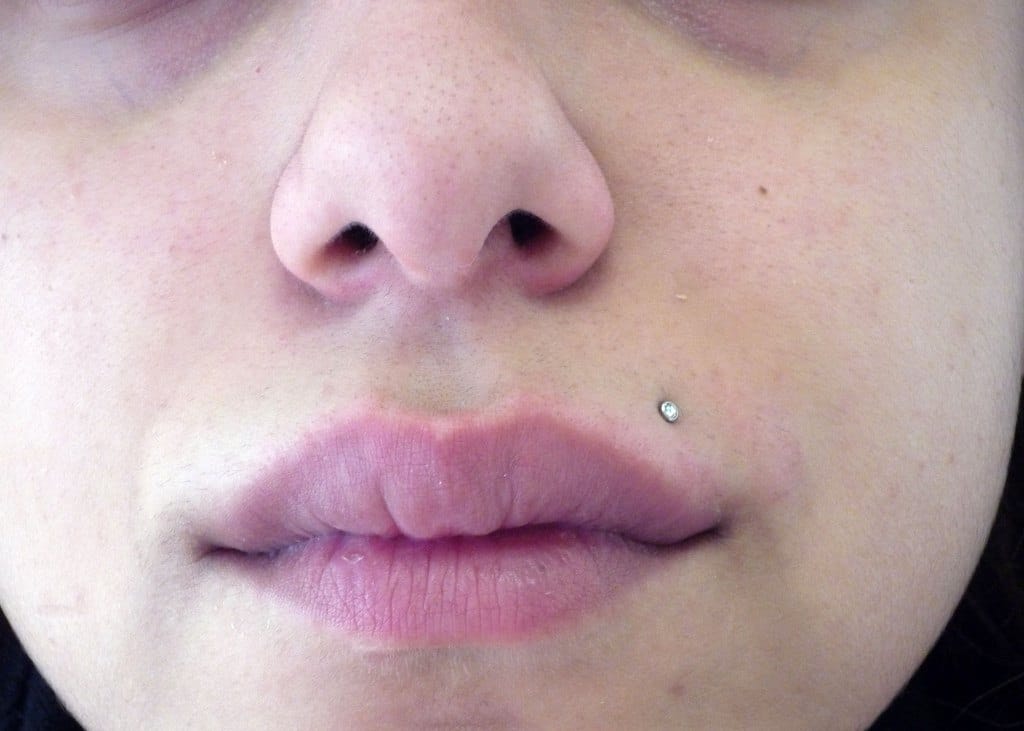 woman with herpes 2