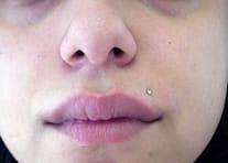 woman with herpes