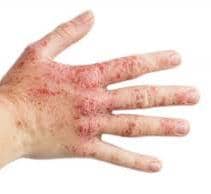 Lyme disease