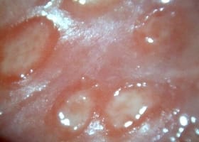 herpes on gummy