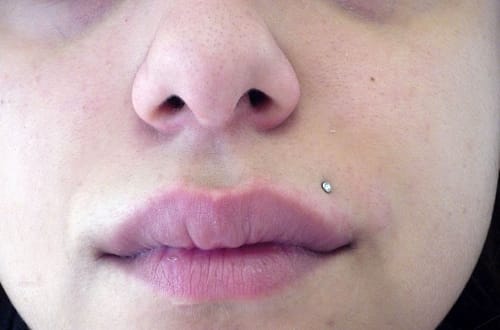 woman with herpes 2