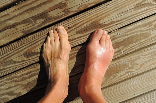 swollen big toe