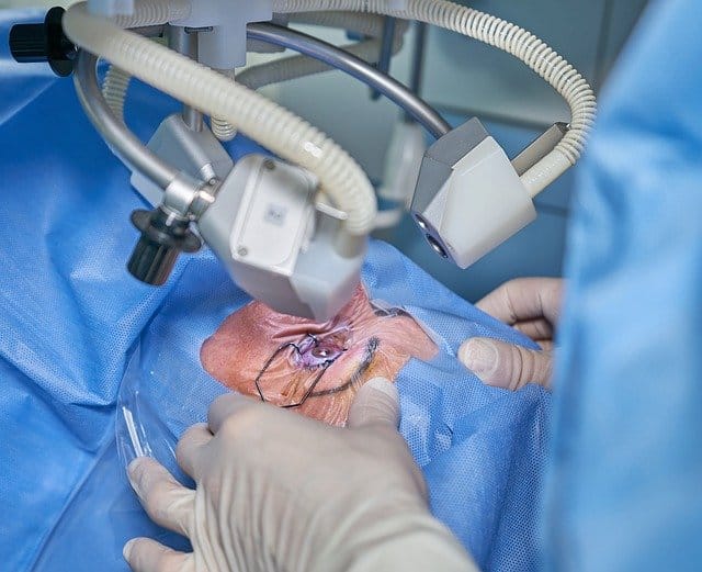 eye-laser-surgery-
