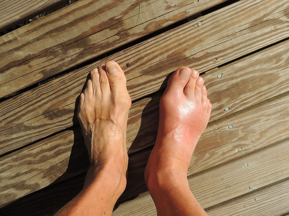 swollen big toe